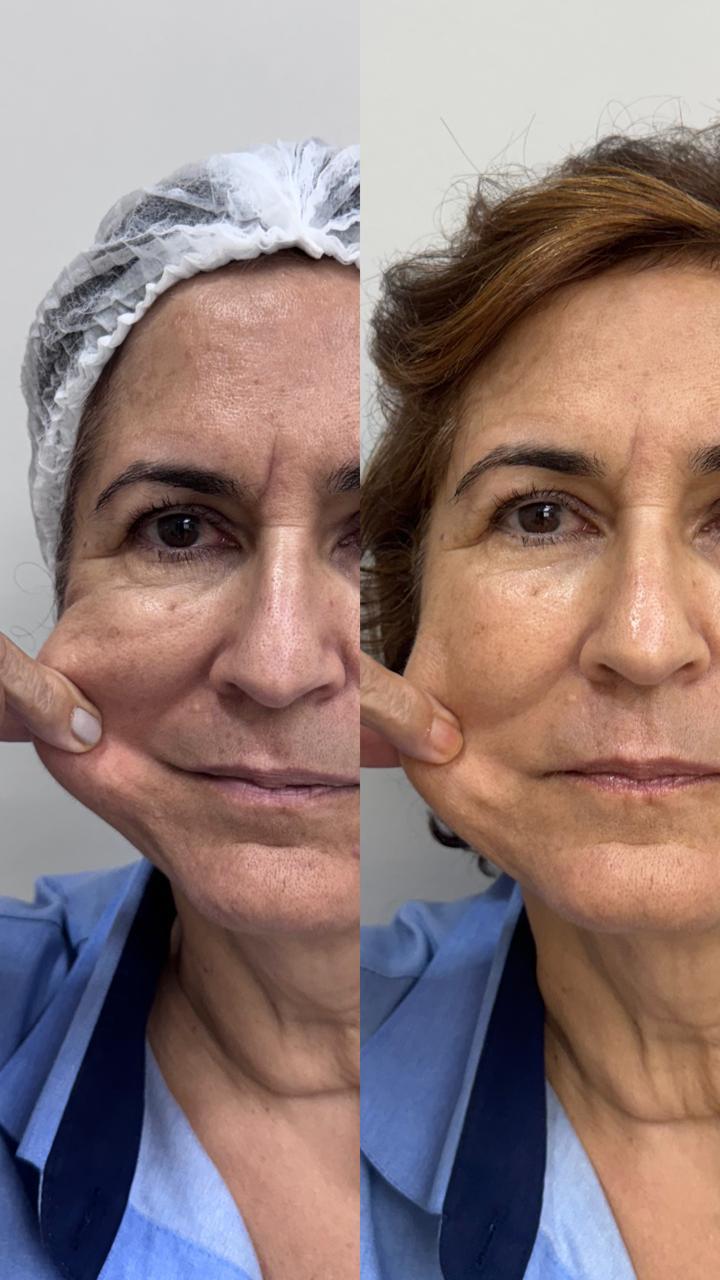 Bioestimulador de colágeno injetável