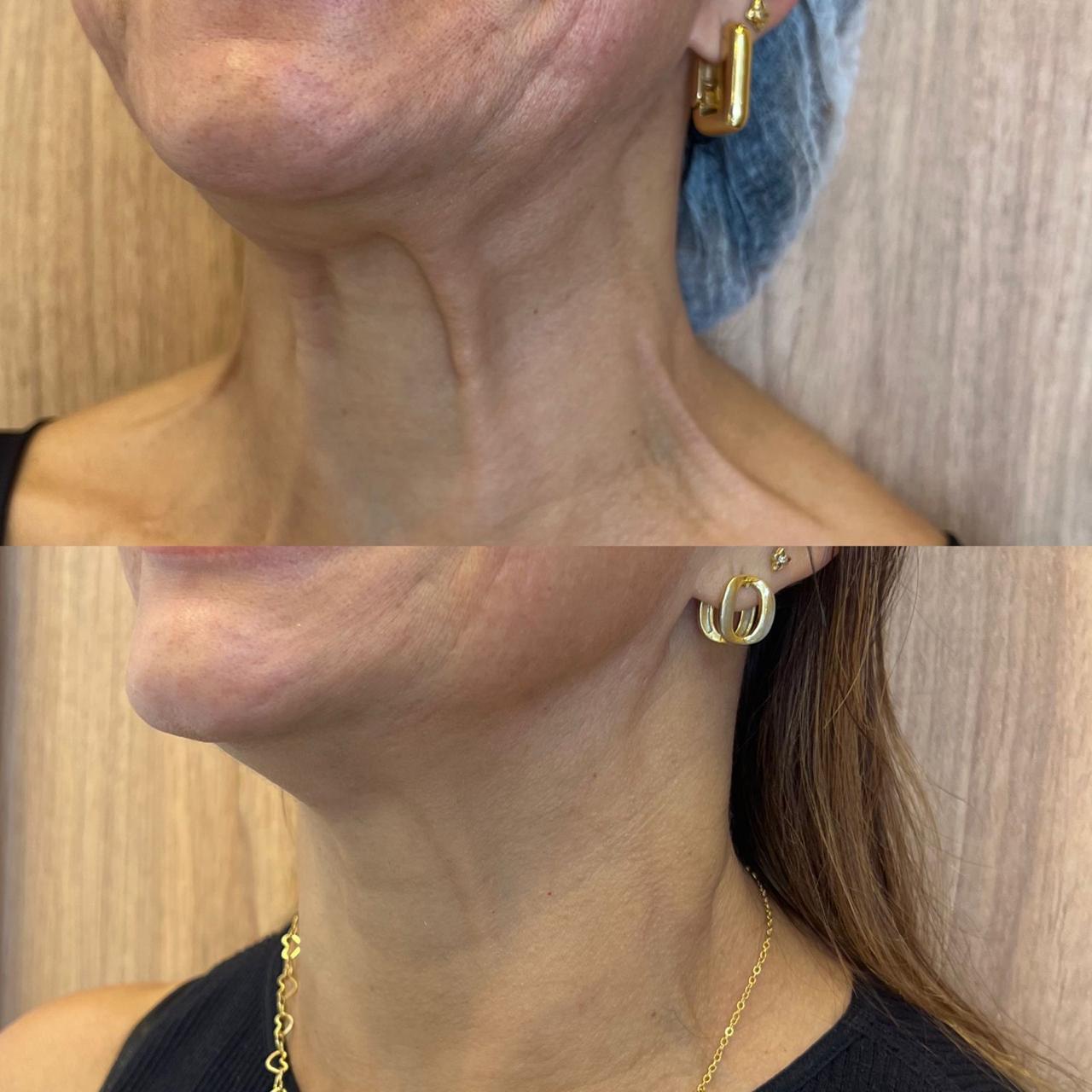 Antes e depois de bioestimulador de colágeno injetável no pescoço