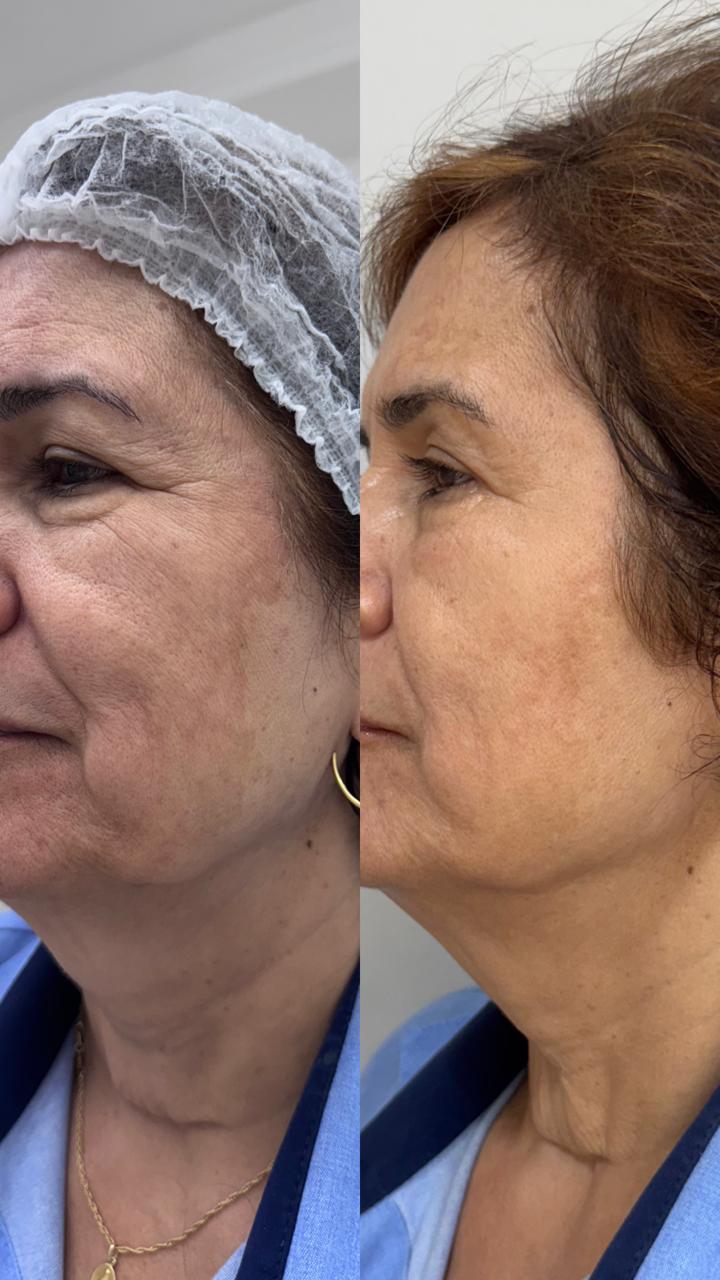 Antes e depois de bioestimulador de colágeno injetável na face