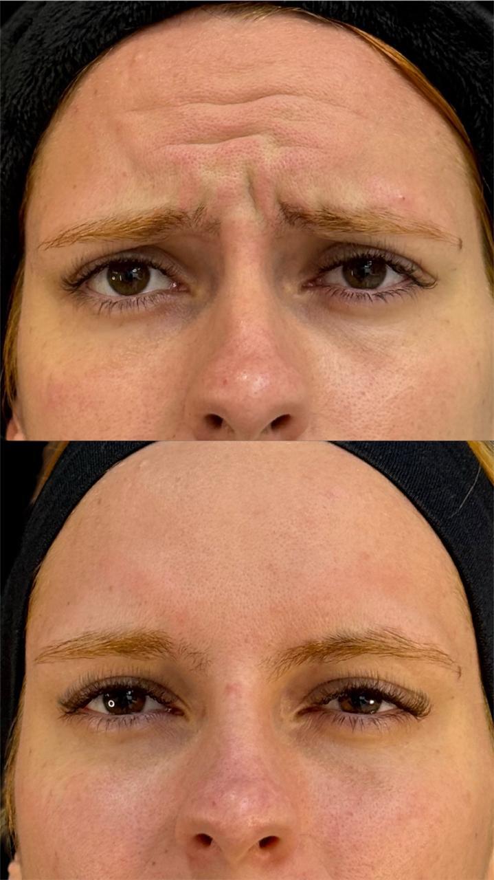 Antes e depois de toxina botulínica nas linhas de expressão