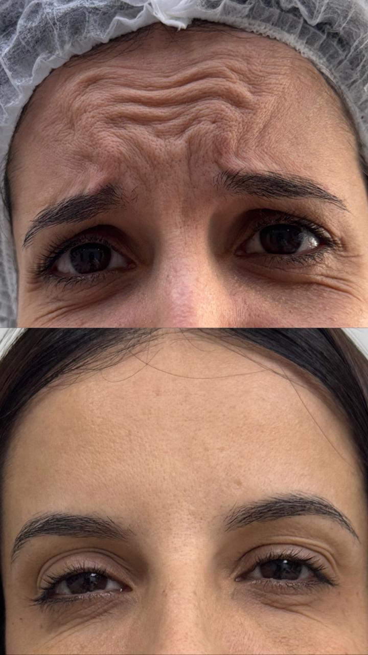 Antes e depois de toxina botulínica no terço superior