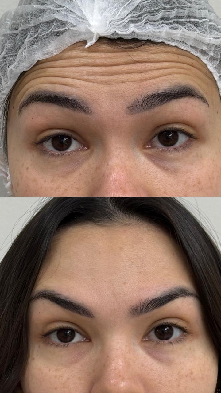Antes e depois de toxina botulínica na testa