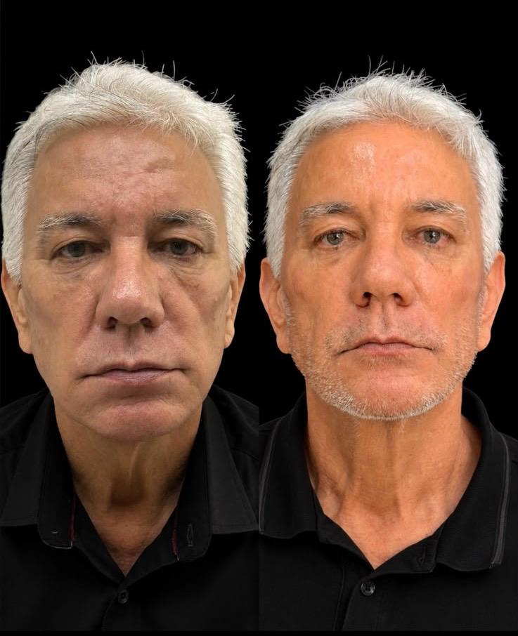 Antes e depois de harmonização facial em paciente masculino