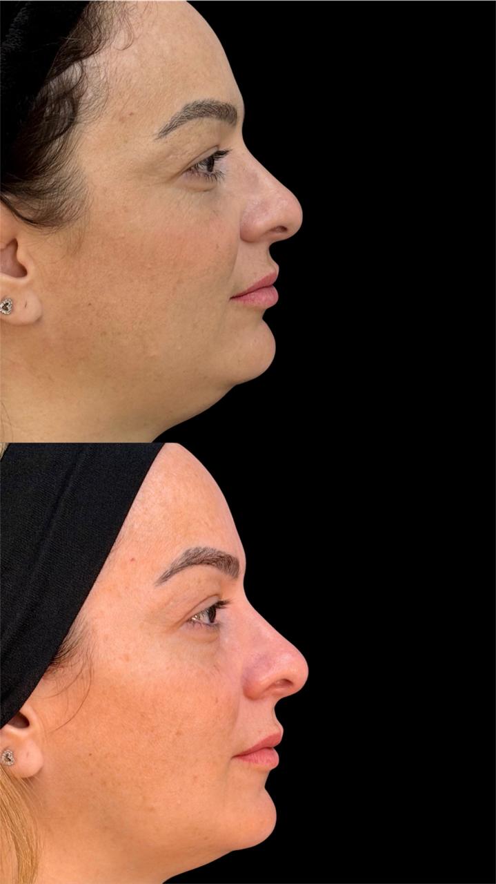 Antes e depois de harmonização facial em vista de perfil
