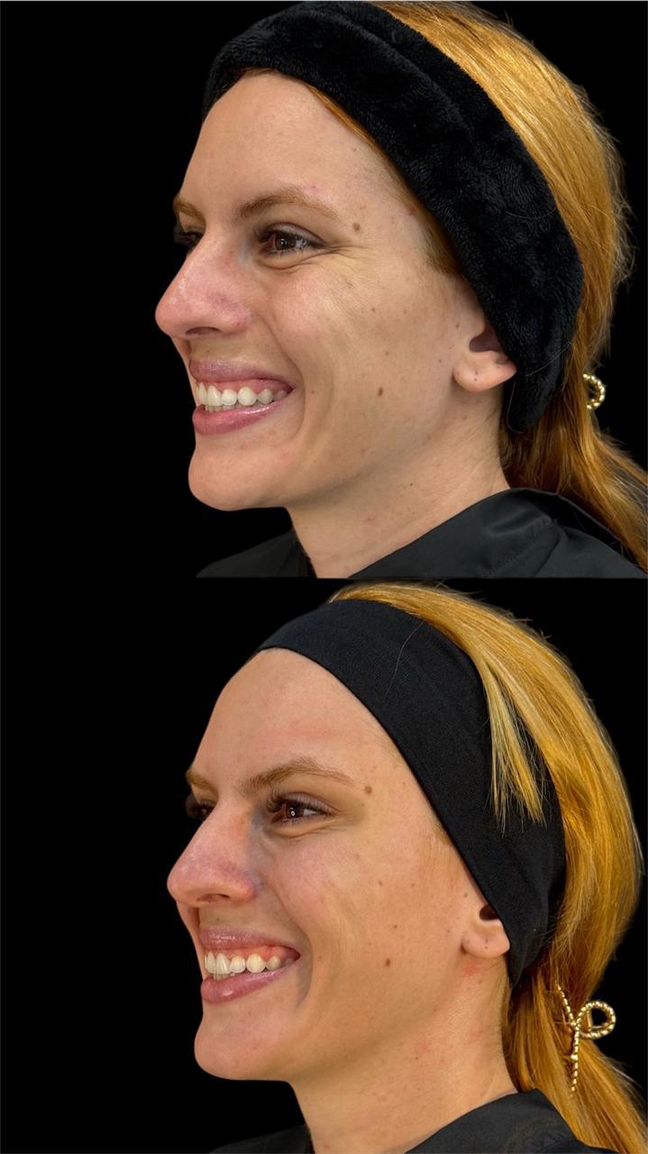Antes e depois de harmonização facial em vista lateral