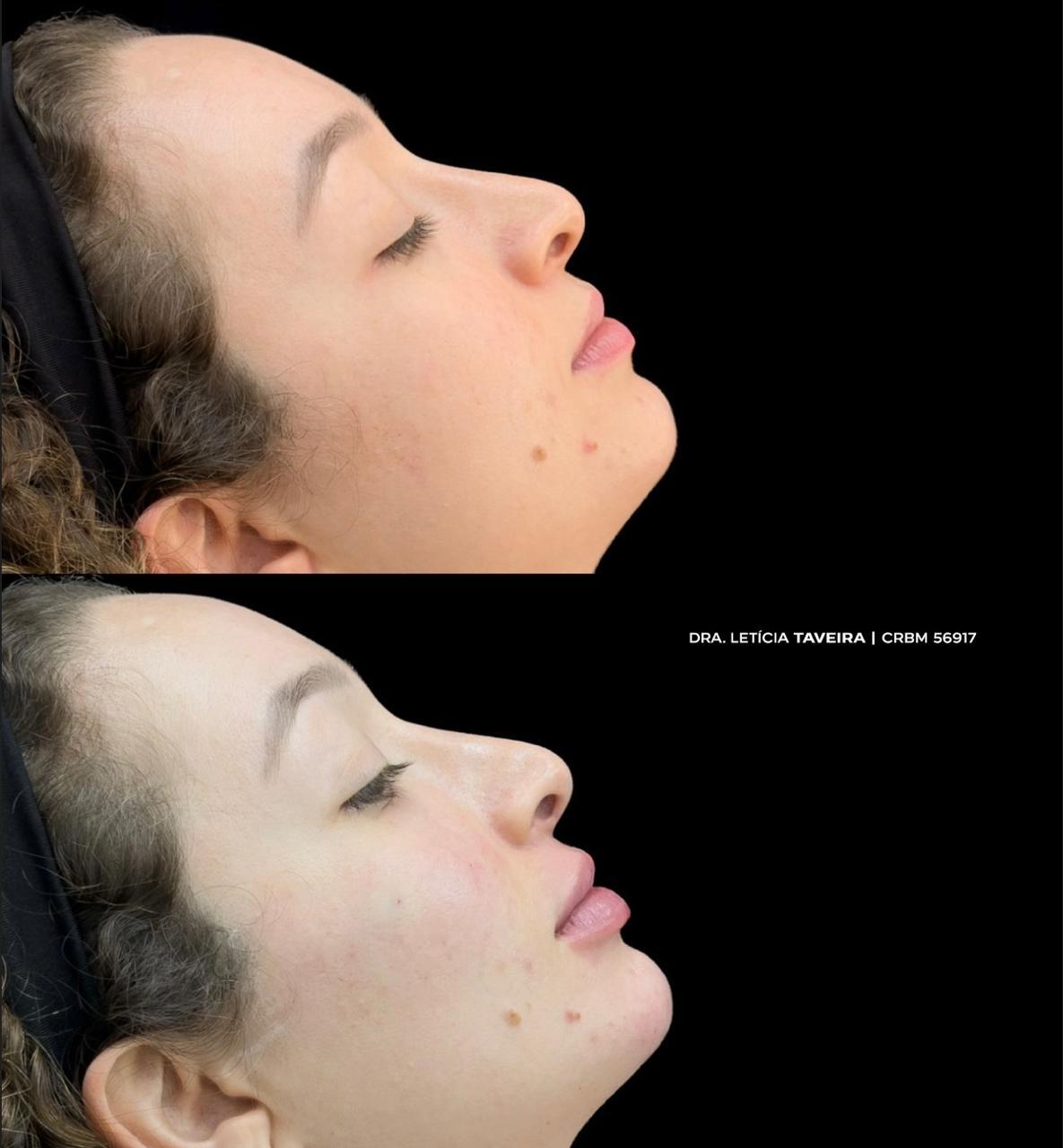 Antes e depois de perfiloplastia