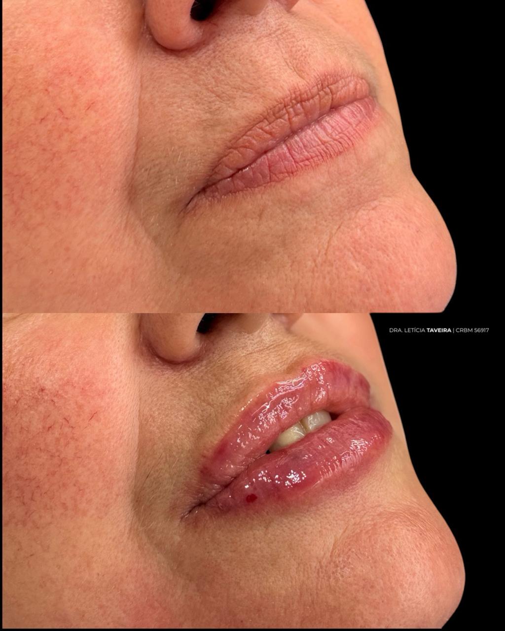 Antes e depois de preenchimento labial